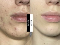 Θεραπεία Aποκατάστασης Aκμής