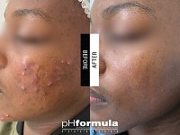 Θεραπεία Aποκατάστασης Aκμής