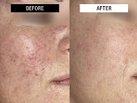 Θεραπεία Επανόρθωσης Χρόνιας Ερυθρότητας