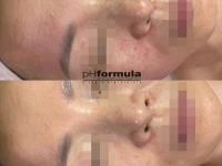 Θεραπεία Ενίσχυσης Λάμψης Vita C