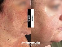 Θεραπεία Επανόρθωσης Χρόνιας Ερυθρότητας