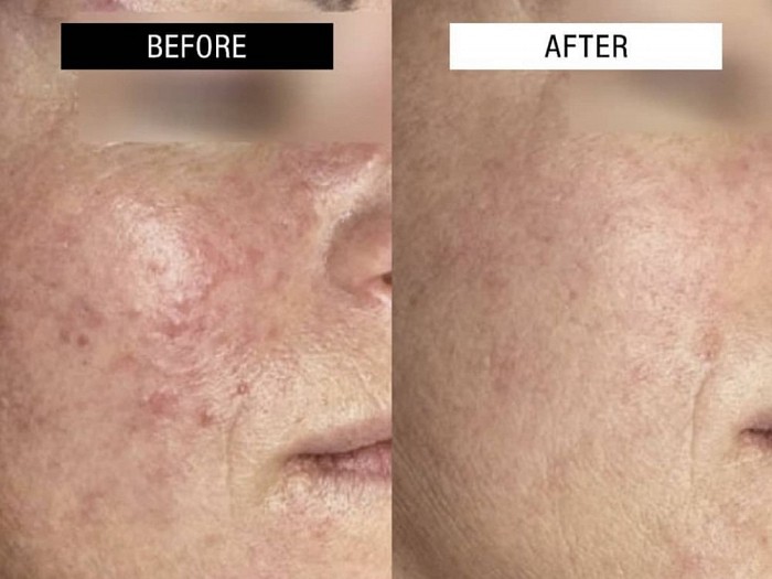 Θεραπεία Επανόρθωσης Χρόνιας Ερυθρότητας