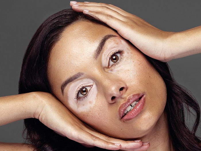 Θεραπεία Επανόρθωσης Χρόνιας Ερυθρότητας